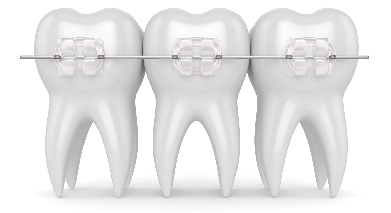 Ortodoncia en adultos: ¿Merece la pena? Resolvemos todas tus dudas