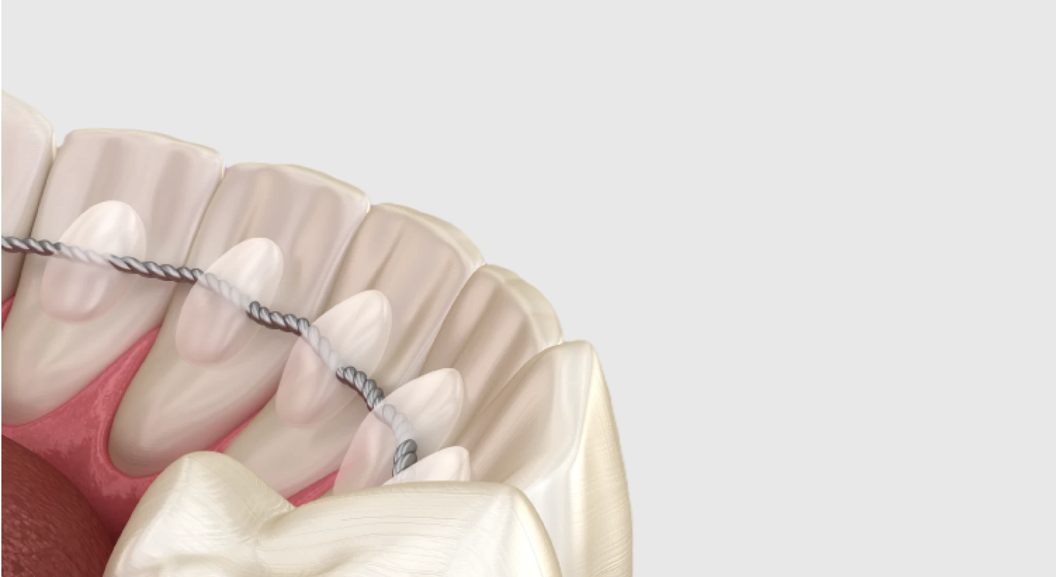 “¡Mis dientes se están moviendo!” 😬 El precio de olvidar el retenedor dental